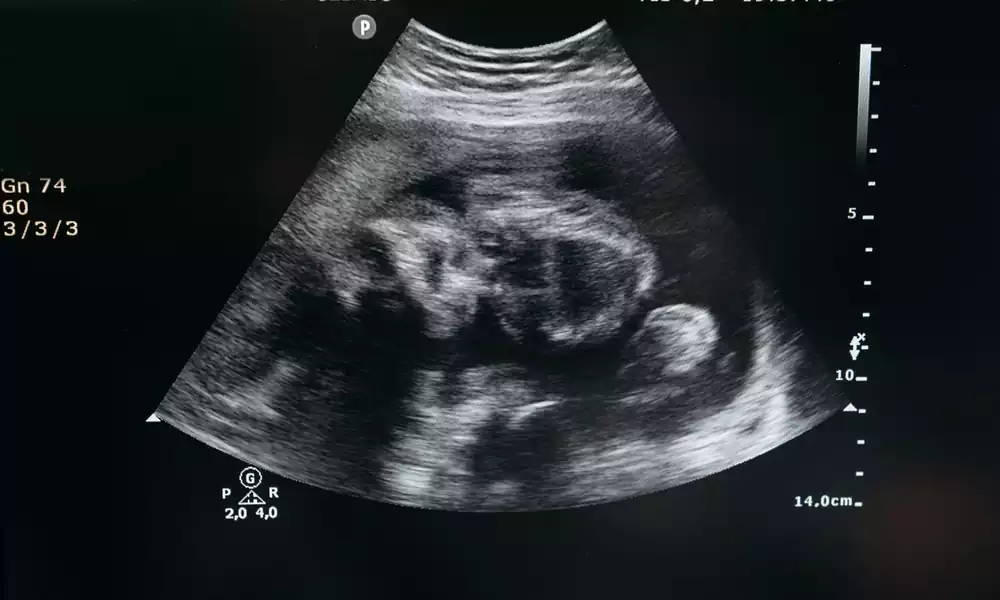 IVF costs
